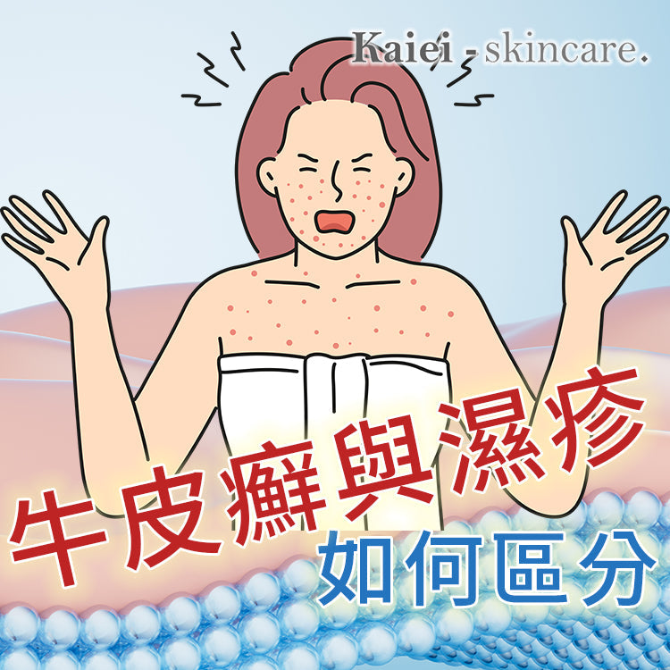 牛皮癬與濕疹如何區分