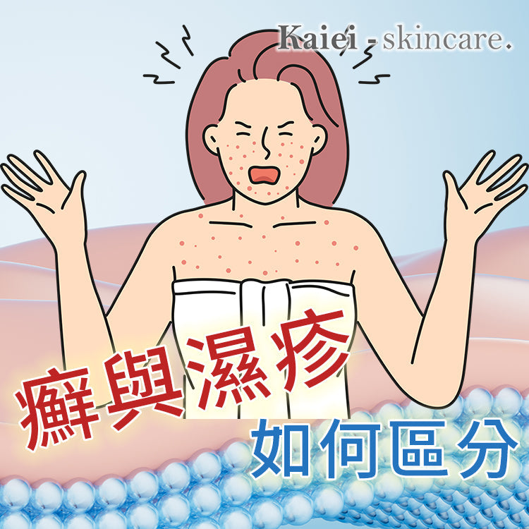 癬與濕疹如何區分