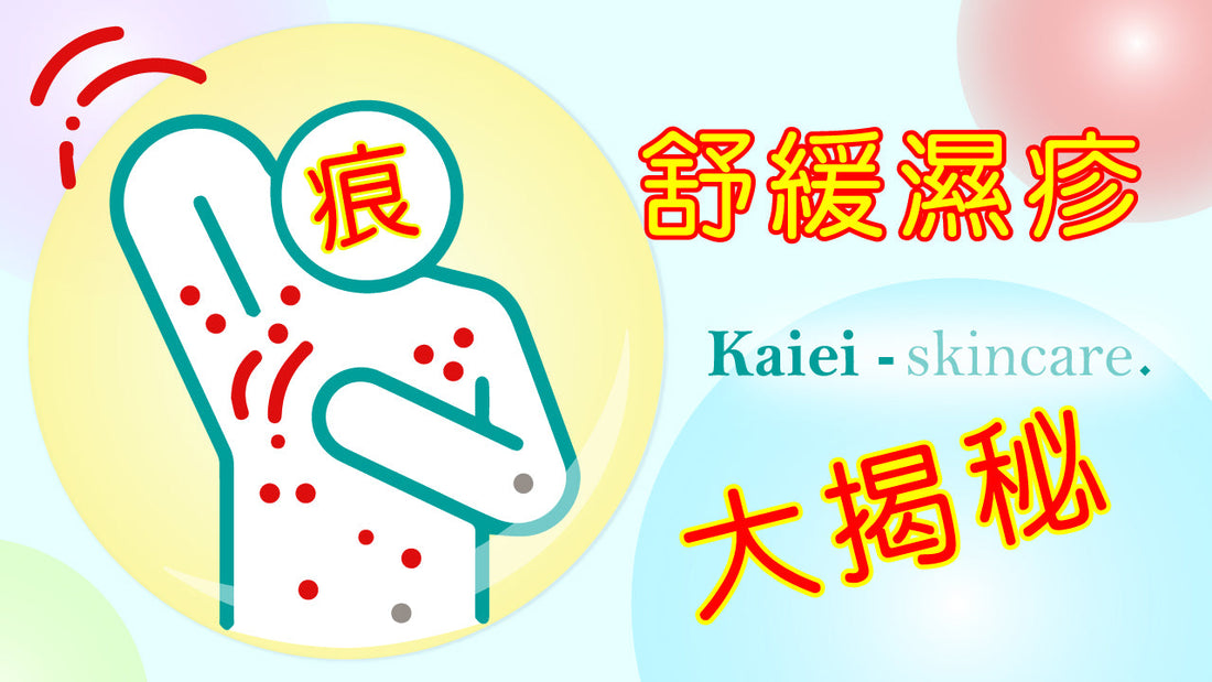 不使用類固醇也能舒緩皮膚，濕疹患者最推薦的舒緩濕疹大揭秘