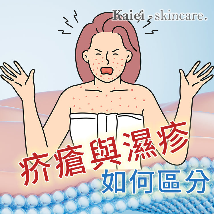 疥瘡與濕疹如何區分