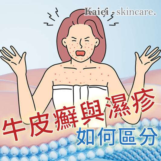 牛皮癬與濕疹如何區分