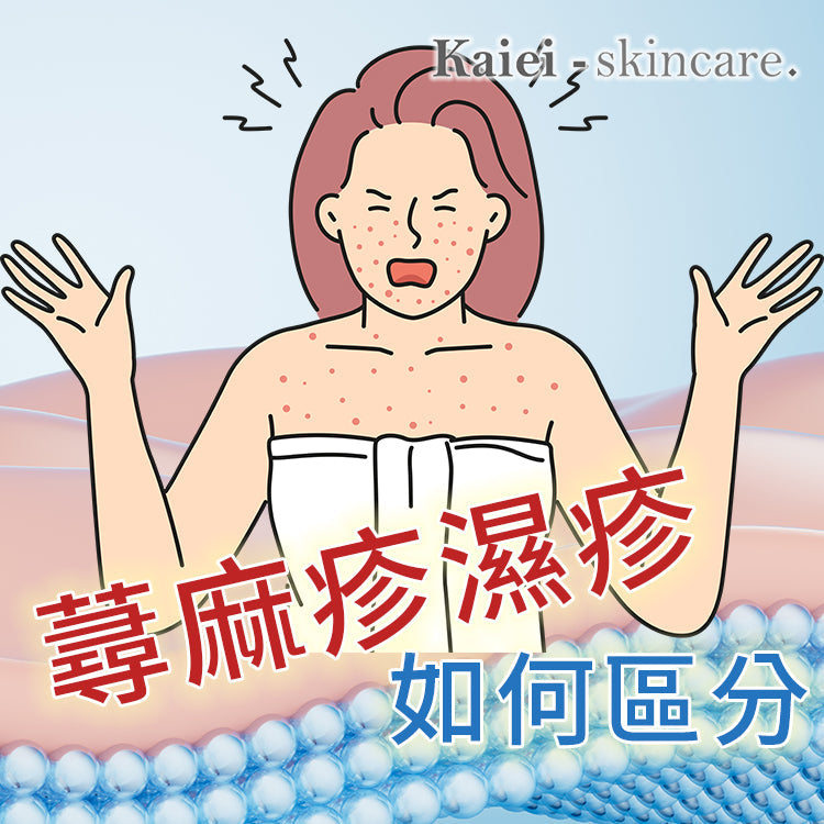 蕁麻疹與濕疹如何區分
