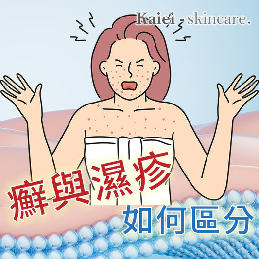 癬與濕疹如何區分